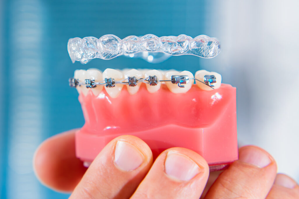 Alternatives to Braces in Coeur d'Alene